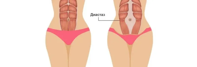 Обложка курса «[birthlight_training] Диастаз! Что делать? (Франсуаза Фридмен)»