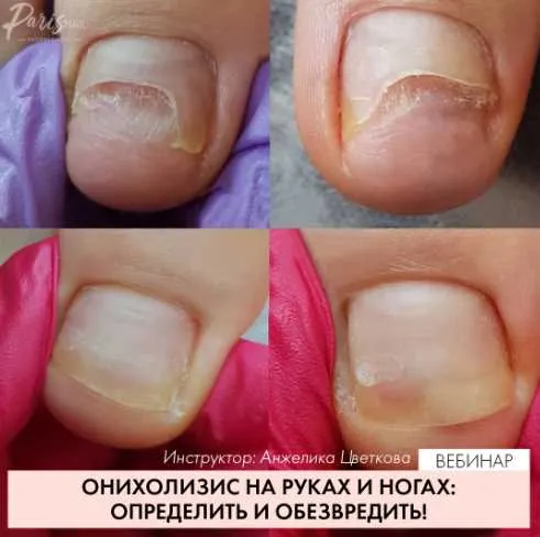 Скачать курс «Вебинар Онихолизис  методы обработки август 2019 (Карина Шурыгина)» — слив курса