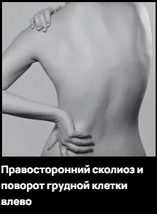 Скачать курс «Правосторонний сколиоз и поворот грудной клетки влево (Александр Волоткевич)» — слив курса