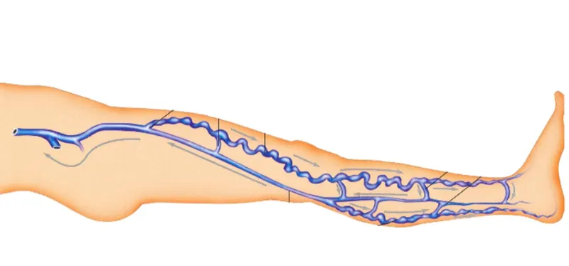 Скачать курс «[Sigh Energy] Лечение варикозного расширения вен Powerful Plus + 11x (Extra Strong). Varicose veins healing Powerful Plus +11x(Extra Strong)» — слив курса