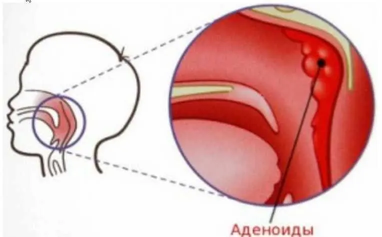 Скачать курс «Аденоиды казнить нельзя помиловать (Елена Леднева)» — слив курса