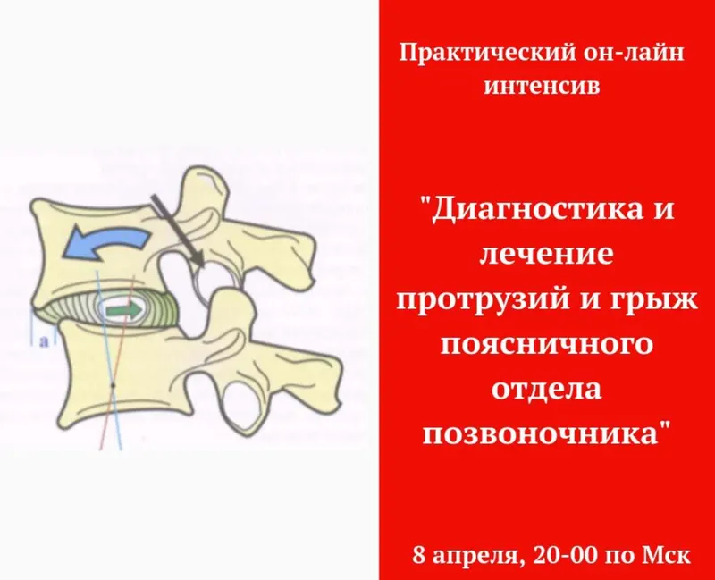 Скачать курс «Диагностика и лечение грыж поясничного отдела (Игорь Атрощенко)» — слив курса