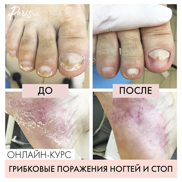 Скачать курс «[parisnail] Грибковое поражение ногтей и кожи стоп (Карина Шурыгина)» — слив курса
