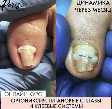 Скачать курс «[ParisNail] Ортониксия. Титановые сплавы и клеевые системы (Карина Шурыгина)» — слив курса