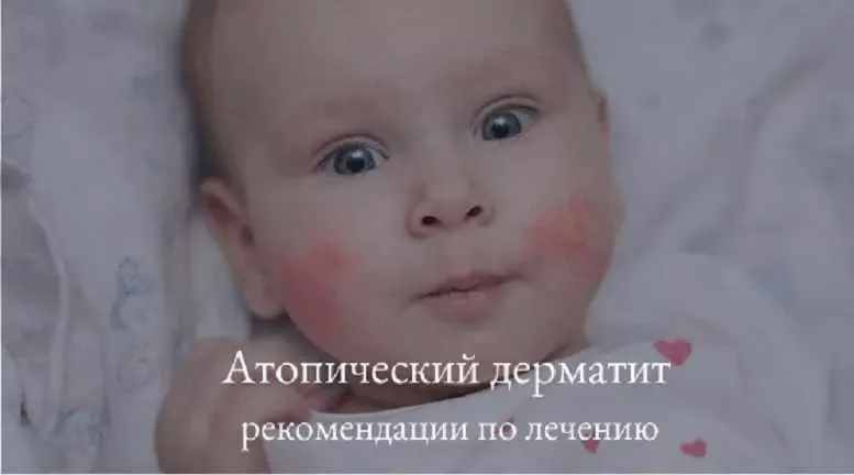 Скачать курс «Про атопический дерматит от замечательного автора (Ольга Жоголева)» — слив курса
