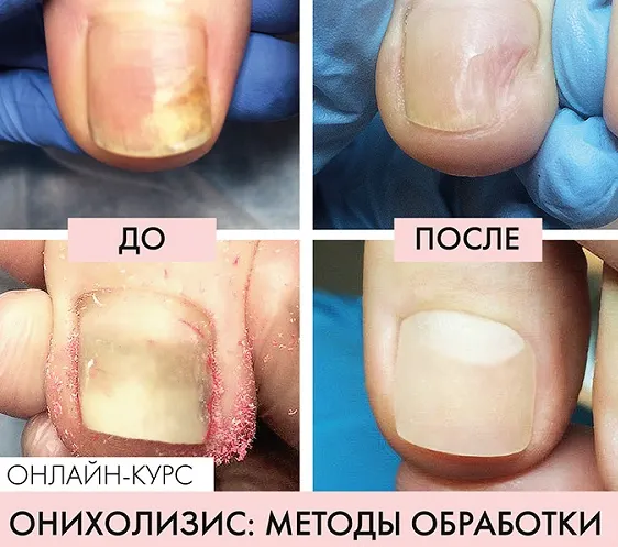 Скачать курс «Онихолизис (Карина Шурыгина)» — слив курса